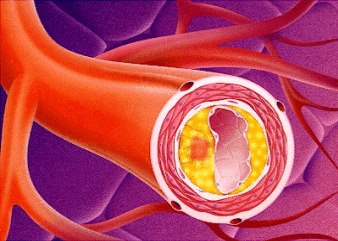 placca arteriosa
