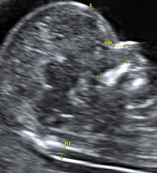 ultra screening (bi-test) gravidanza terzo mese